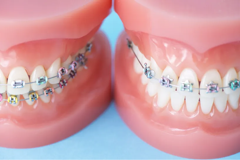 メタルブラケット