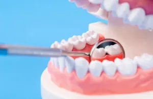 歯のクリーニングで期待できる予防効果