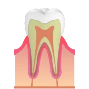 C0 脱灰　虫歯のはじまり
