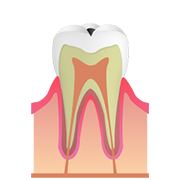 C1 歯の表面（エナメル質）の虫歯