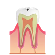 C1 歯の表面（エナメル質）の虫歯