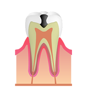 C2 歯の中（象牙質）の虫歯