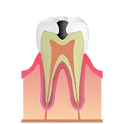 C2 歯の中（象牙質）の虫歯