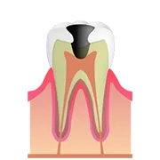 C3 神経まで進行した虫歯