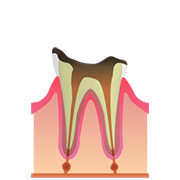 C4 歯の根まで進行した虫歯