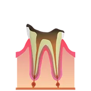 C4 歯の根まで進行した虫歯